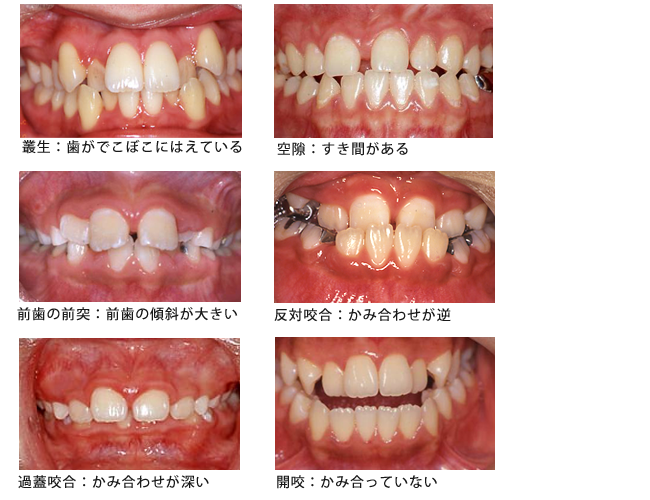 不正咬合の種類