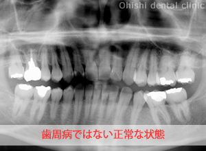 歯周病の症例