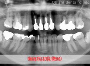 歯周病の症例