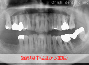 歯周病の症例