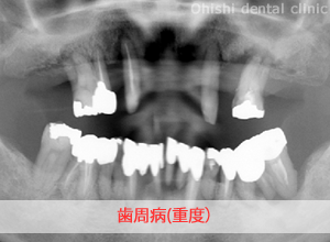 歯周病の症例