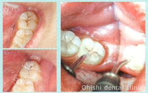 レーザーによるむし歯の治療例