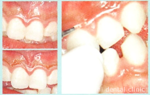 レーザーによる歯ぐきの黒ずみ（色素沈着）除去