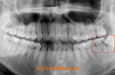 親知らずの症例